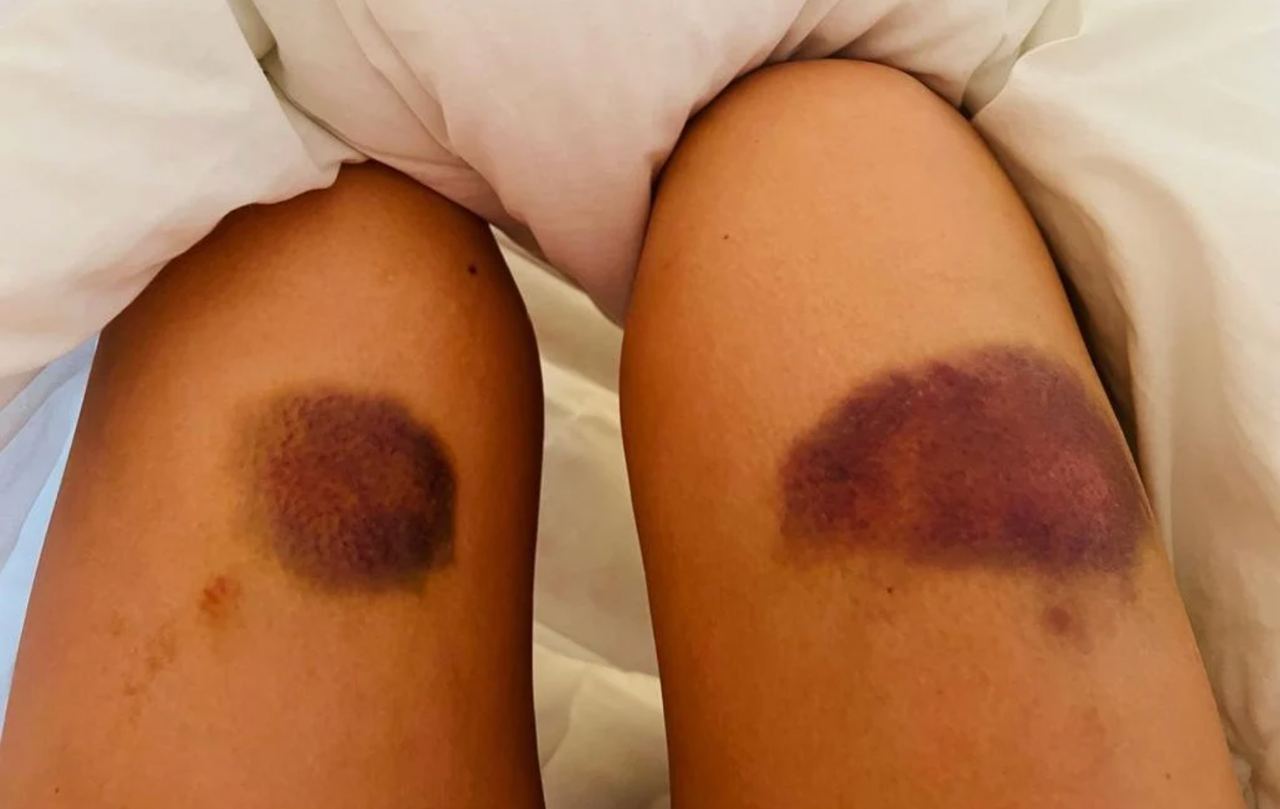 Беженка из Украины пожаловалась на жестокое избиение со стороны ливанца в Германии